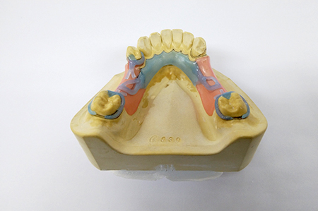 金具の材料を張り付けた歯の模型