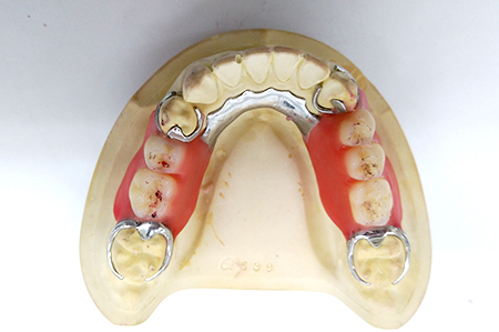 歯茎の部分をプラスチックに置き換えた入れ歯